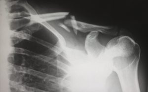 xray showing broken clavicle